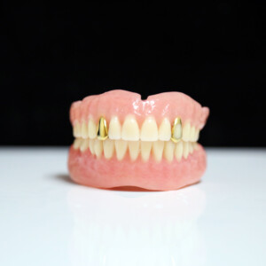 Custom denture with gold inlays fabricated by Weil Dental Lab for enhanced durability and premium esthetics Custom denture with gold inlays fabricated by Weil Dental Lab for enhanced durability and premium esthetics