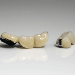 High-quality precision attachment case providing stable, clasp-free retention Precision attachment dental case fabricated by Weil Dental Lab for secure retention and discreet esthetics