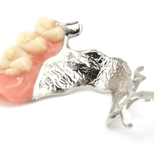 High-quality cast partial denture designed for durability and patient comfort High-quality cast partial denture designed for durability and patient comfort
