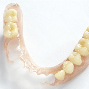 Removable partial denture designed to replace missing teeth comfortably Removable partial denture designed to replace missing teeth comfortably